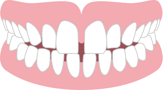 すきっ歯・歯と歯の間が広くあいている（空隙歯列）