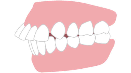 上の歯が出ている・出っ歯（上顎前突）