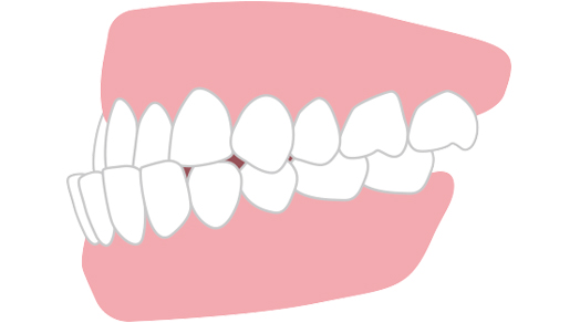 下の歯が出ている・受け口（下顎前突）