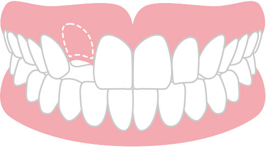 永久歯が生えてこない（埋伏歯）
