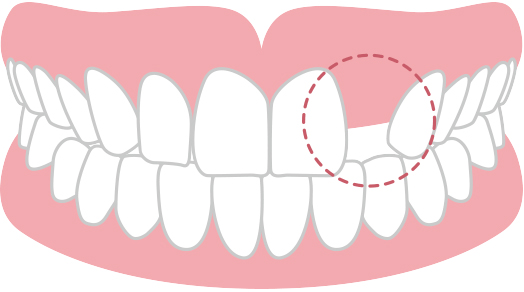 永久歯の数が少ない（先天性欠如）