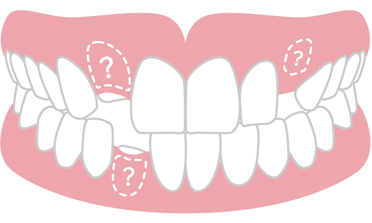 永久歯が3本以上生えてこないために起こる咬合異常