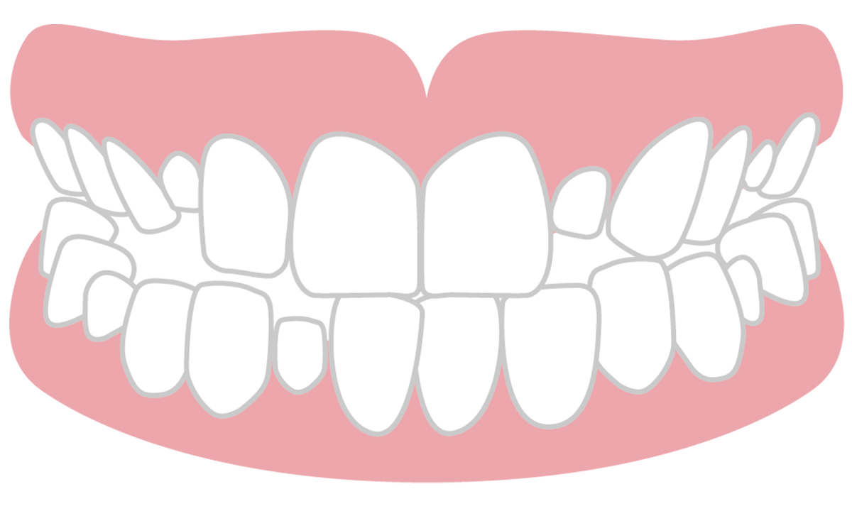 永久歯が生まれつき6本以上欠損しているために起こる咬合異常