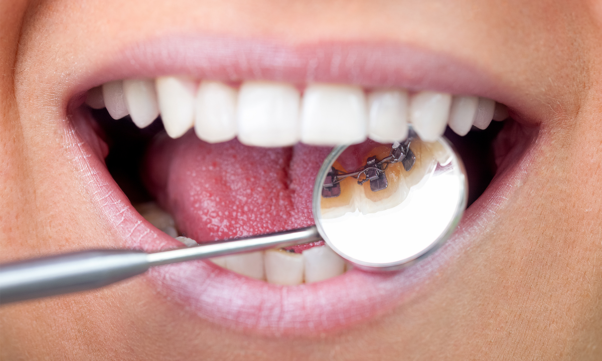 歯の裏側から矯正する舌側矯正とは